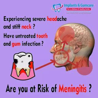 meningitis from tooth infection symptoms